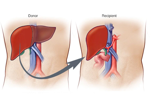Liver Cancer Surgery