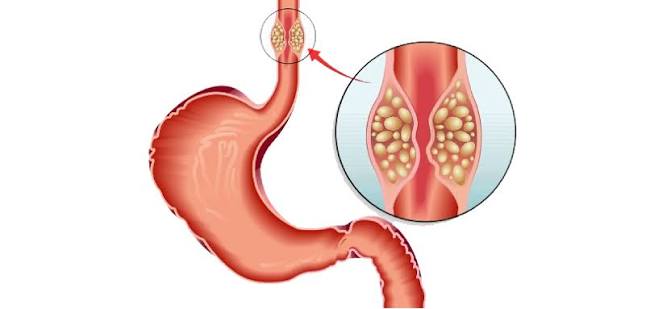 Esophagus Cancer Surgery